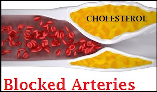 blocked arteries by cholesterol