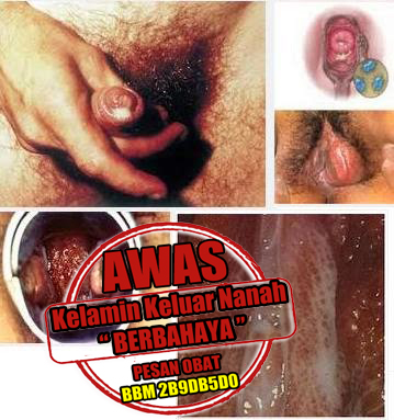 Pengobatan Alternatif Untuk Kencing Nanah Pengobatan Alternatif Untuk Kencing Nanah