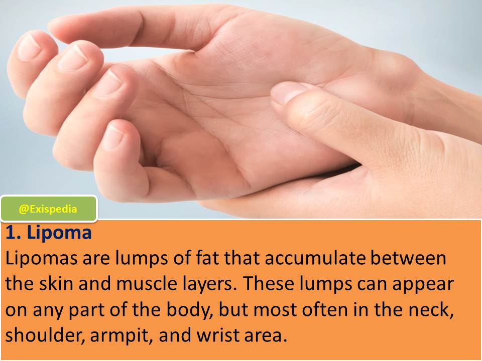 4 Common Types Of Lumps On The Wrist Exis Pedia