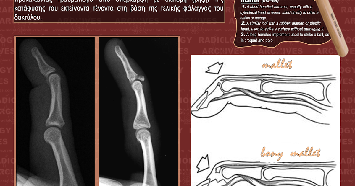 Radiology Archives Learning & Have Fun n.2 Mallet Finger