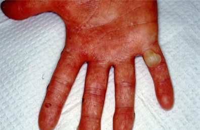 大疱性表皮松解症的手足大疱