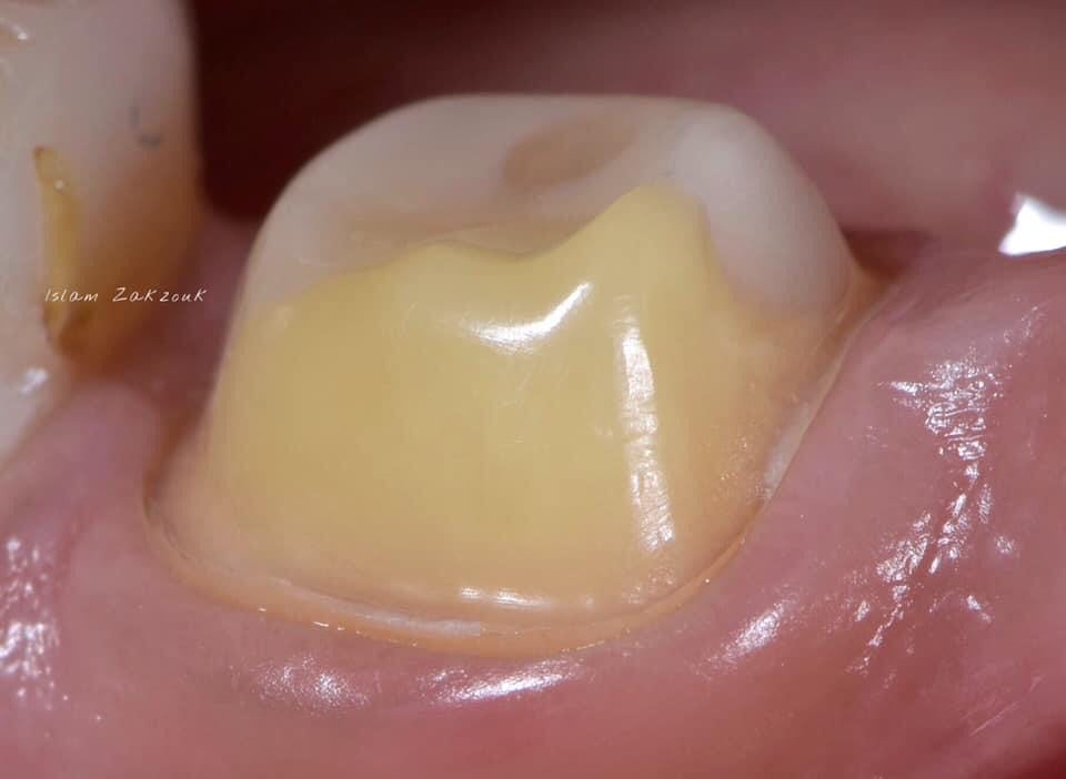 Cheap Dental Crown Repair