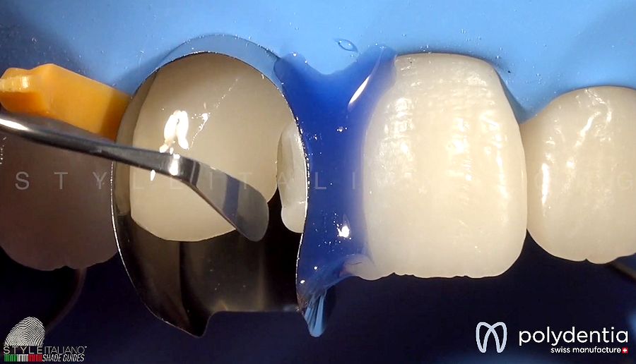 OPERATIVE DENTISTRY Class III anterior direct composite restoration
