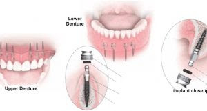 Thông tin chung về trồng răng sứ bằng cấy ghép Implant