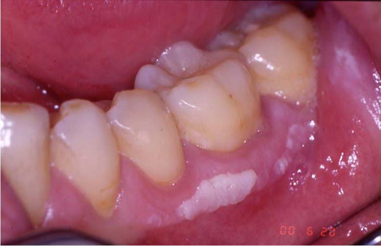 Dentistry Lectures For MFDS MJDF NBDE ORE Leukoplakia Note With Images dentistry-lectures-for-mfds-mjdf-nbde-ore-leukoplakia-note-with-images