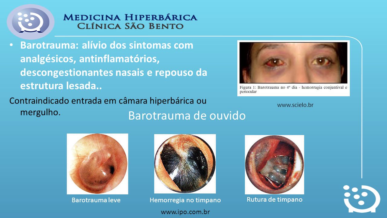 Barotraumatismo Sangramento e Pressão no Ouvido