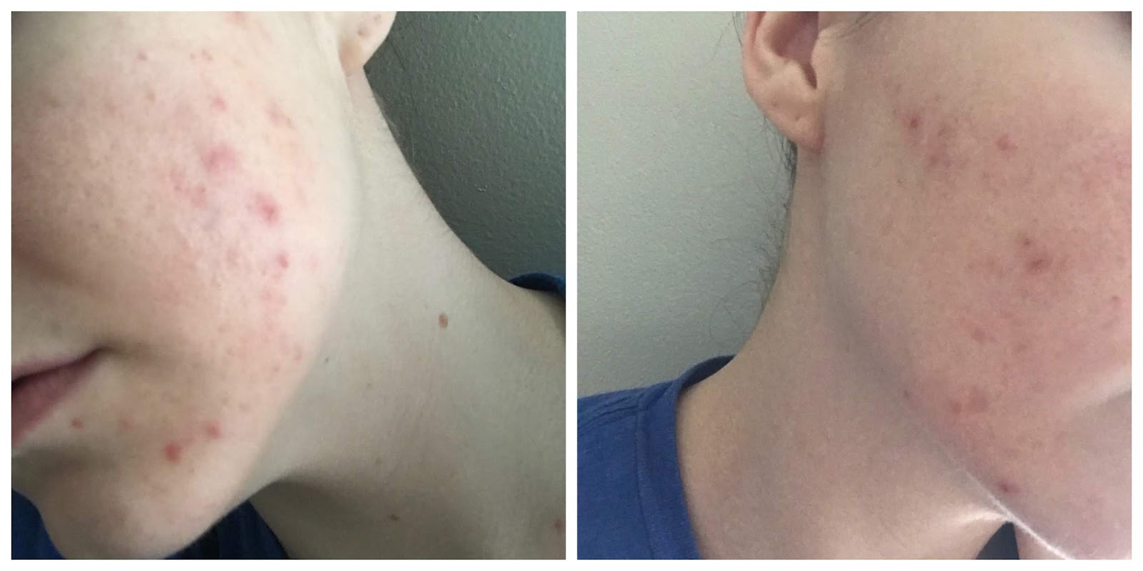 alani nu balance acne