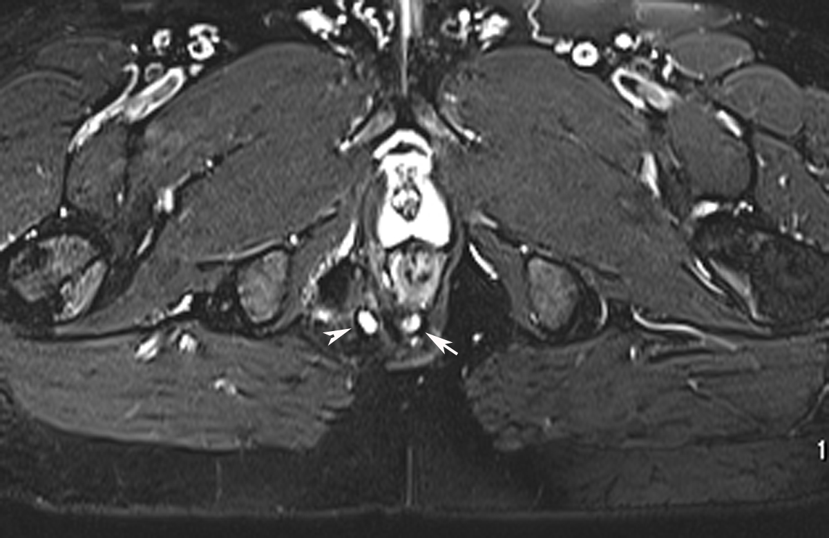 Radiodiagnosis Imaging is AmazingInteresting cases Perianal Fistula