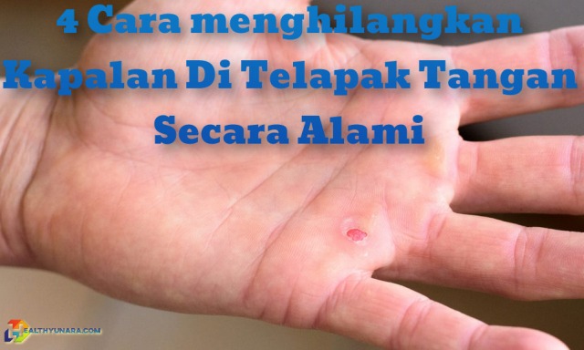 4 Cara menghilangkan Kapalan Di Telapak Tangan Secara Alami 4 Cara menghilangkan Kapalan Di Telapak Tangan Secara Alami