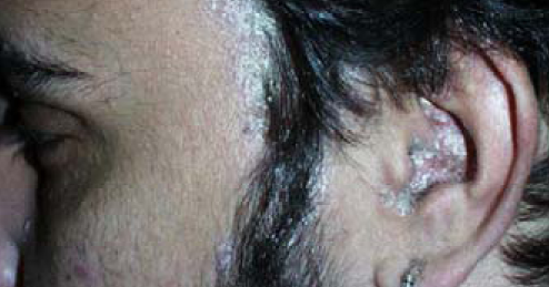 remedios caseros psoriasis cuero cabelludo psoriasis cuero cabelludo las causas y s 237 ntomas de la remedios caseros psoriasis cuero cabelludo psoriasis cuero cabelludo las causas y s 237 ntomas de la
