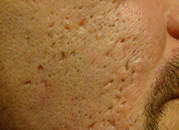 Ice Pick Scars
