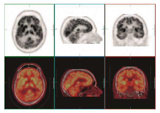 Positron emission tomography (PET) scanning is designed to assess the distribution of tracers labeled with positron-emitting nuclides