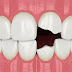 Một số điều cần biết khi bọc răng sứ