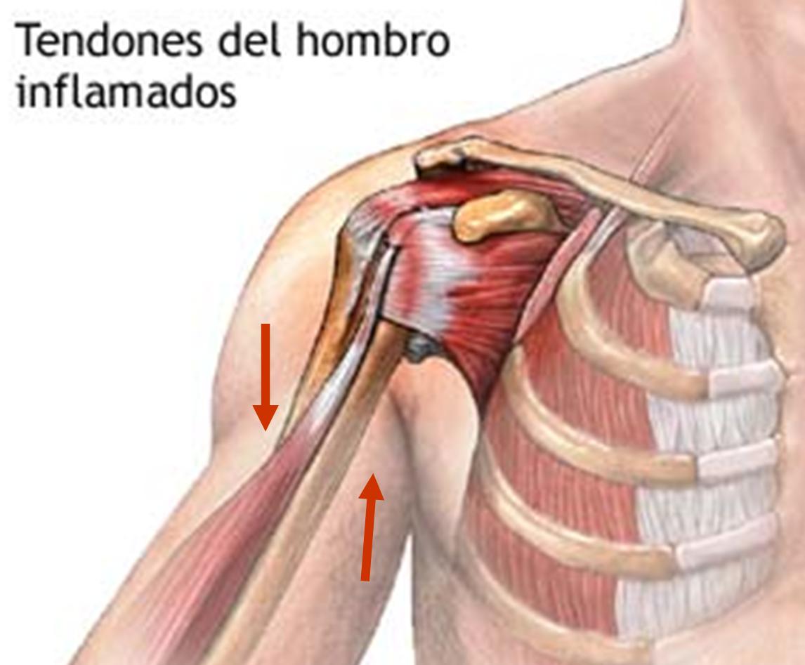 Разрыв плечевого сустава симптомы. Разрыв плечевого сустава. Повреждение связок плечевого сустава.