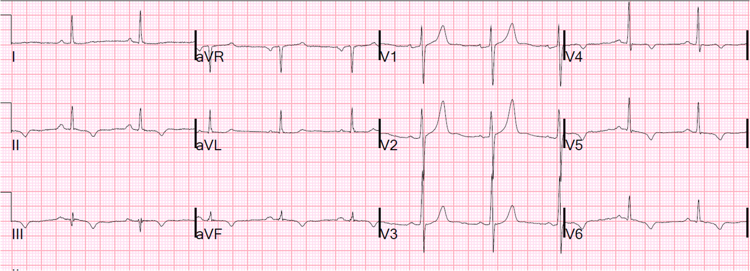 Dr. Smith's ECG Blog Waxing and Waning Chest Pain