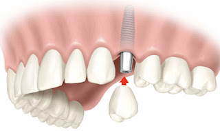 Utilização da Implantologia na Odontologia