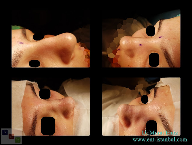 nose aesthetic surgery for female patient, rhinoplasty for women istanbul, nose job in Turkey, one week after rhinoplasty photos