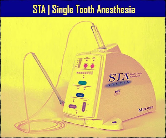 DENTAL EQUIPMENTS: Single Tooth Anesthesia (STA) - North County