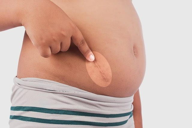 Efek Operasi Usus Buntu Bagi Wanita