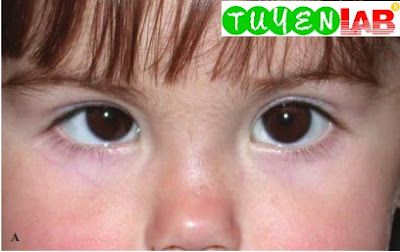 Pediatric Atlas of Strabismus and pseudostrabismus | Free Medical Atlas