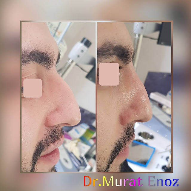 Non surgical nose job with filler, limited filler injection to the nose