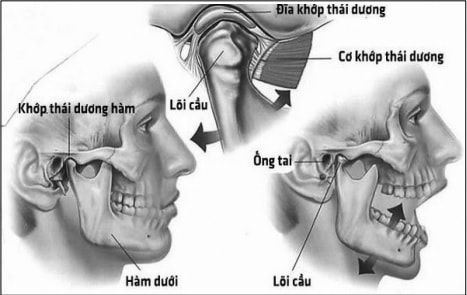 Cách phát hiện bệnh rối loạn khớp thái dương hàm Cách phát hiện bệnh rối loạn khớp thái dương hàm