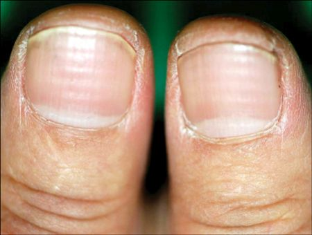 The 5 ways your nails may reveal if you've had COVID
