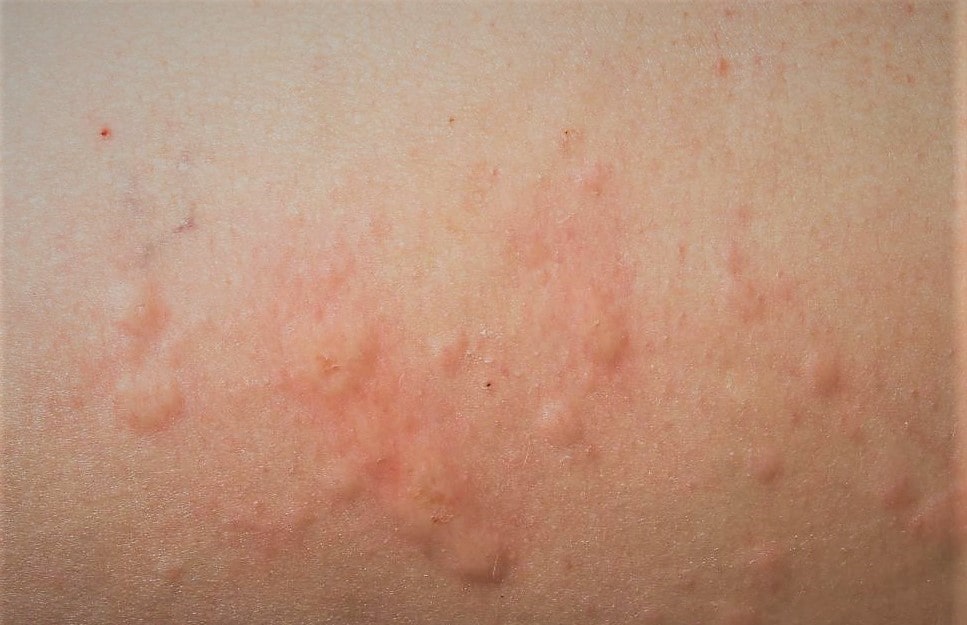 WISH UR HEALTH SKIN ALLERGY Description; Types; Treatment & Home