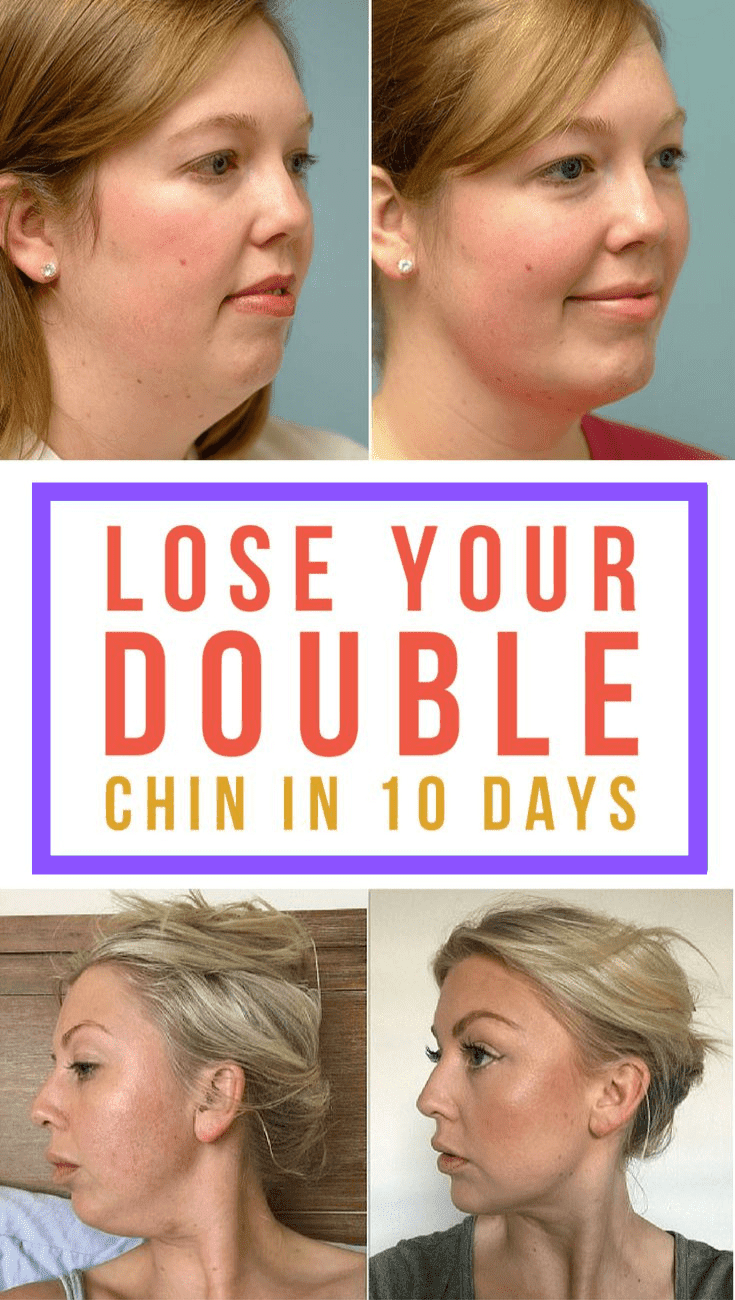 How To Get Rid Of A Double Chin The Quick And Easy Way In A Week Medicine Health Life