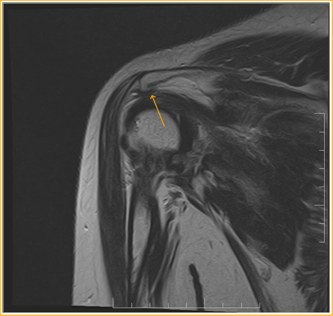 Rotator Cuff Impingement Syndrome Sumer's Radiology Blog