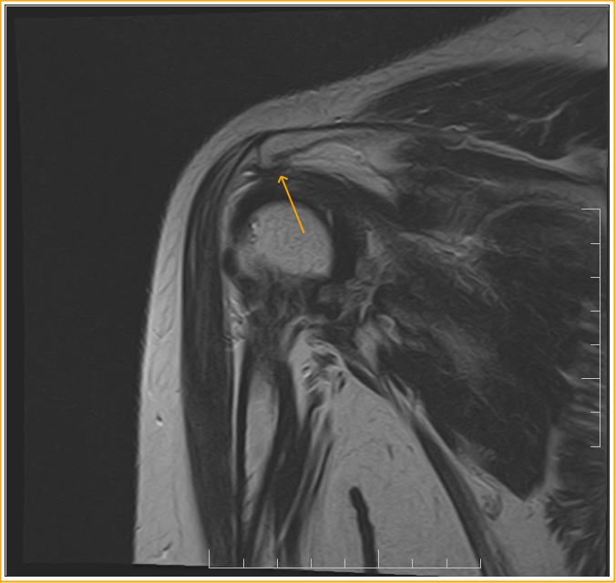 Rotator Cuff Impingement Syndrome Sumer S Radiology Blog