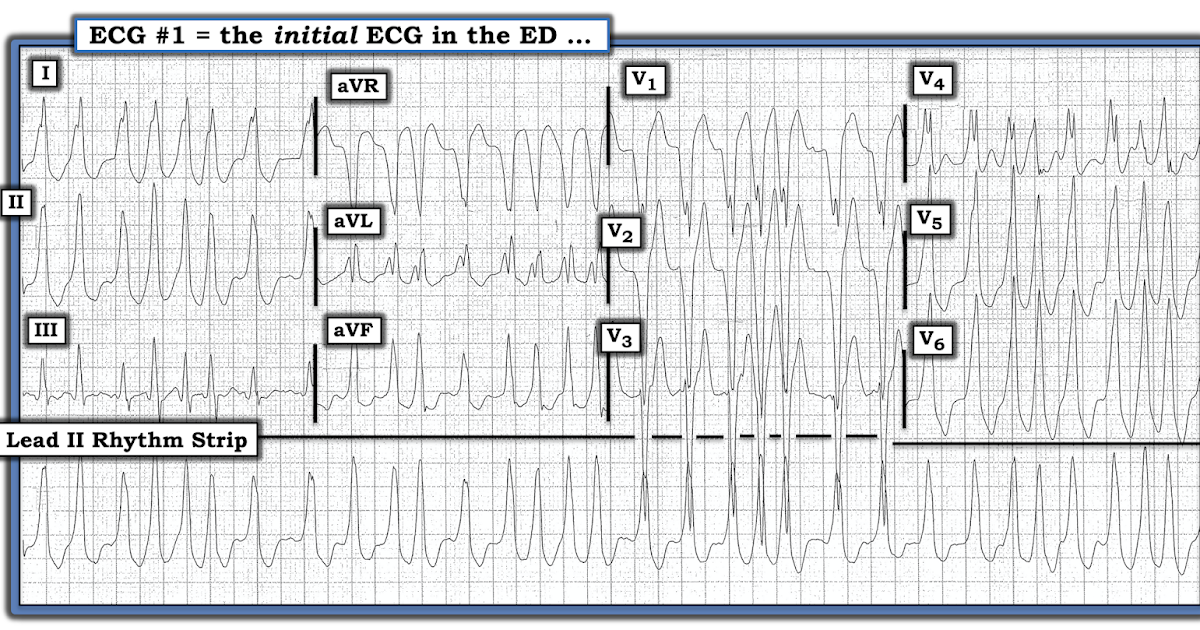 ECG Interpretation ECG Blog 173 (VT AFib Polymorphic WPW)