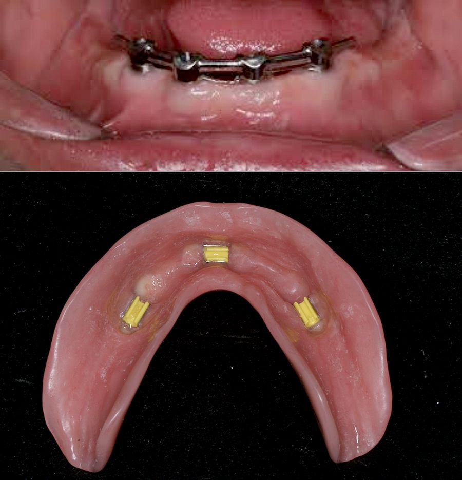 Maxillary Bar Overdenture