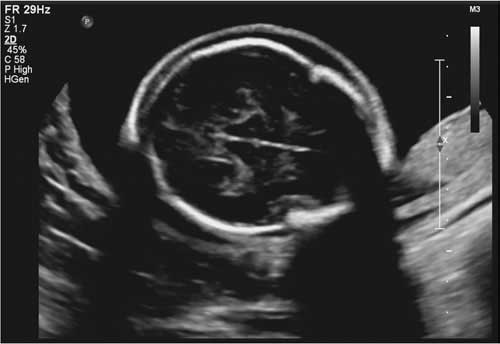 Scalp edema Ultrasound