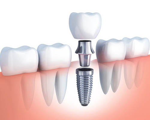 Trồng răng implant bao nhiêu tiền