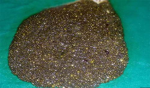 Mengeluh Kesakitan,Ternyata Ditemukan 11.950 Batu Empedu di Tubuh Wanita Ini Mengeluh Kesakitan,Ternyata Ditemukan 11.950 Batu Empedu di Tubuh Wanita Ini