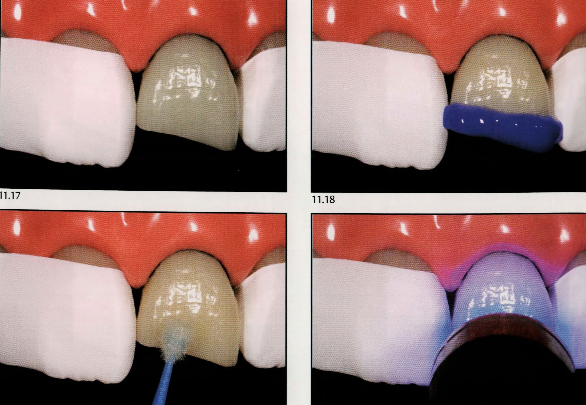 Class IV composite " silicone guide technique " Dental Esthetics