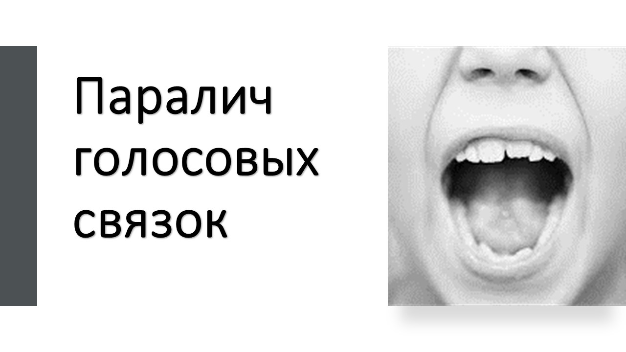 положение связок при парезе гортани. паралич голосовых связок. парез голосовых связок кт. положение голосовых складок при параличах гортани. парез голосовых.
