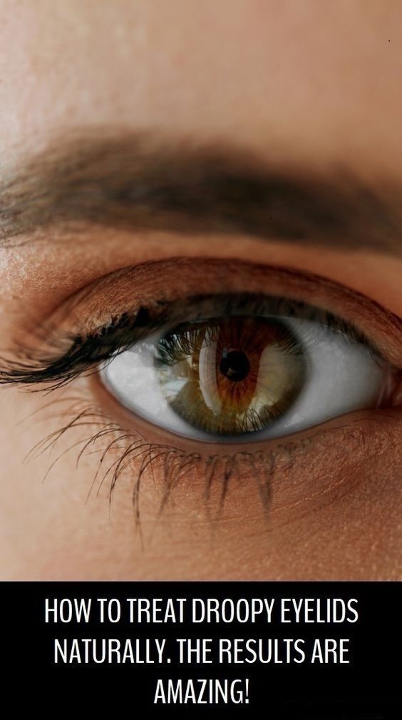 How To Treat Droopy Eyelids Naturally. The Results Are Amazing ...