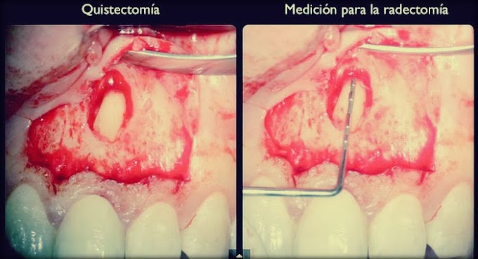 ENDODONCIA: Microcirugía apical de 2.1