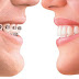 Các phương pháp niềng răng hô phổ biến
