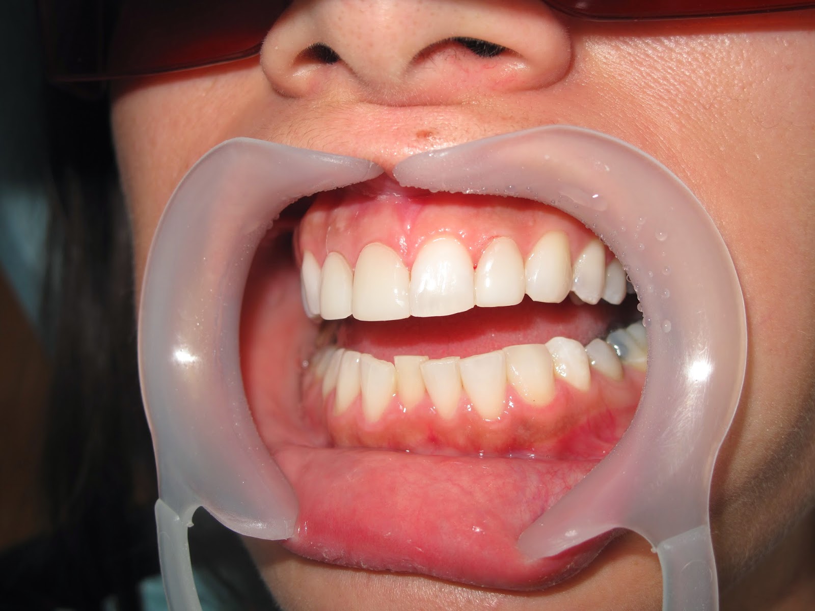 One of the best dental implants laser specialist surgeon in Lebanon