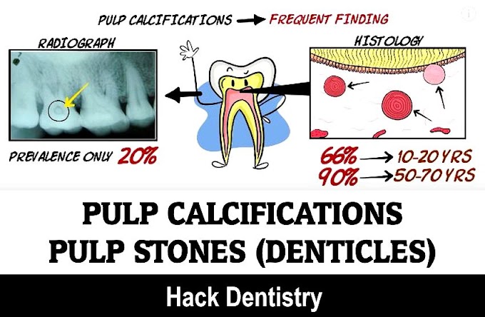 PULP CALCIFICATIONS: Pulp stones (Denticles) and Diffuse linear calcifications