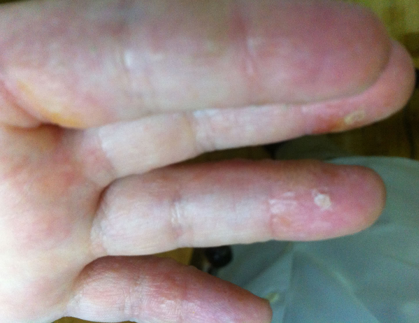 Los análogos de los ungüentos de la psoriasis