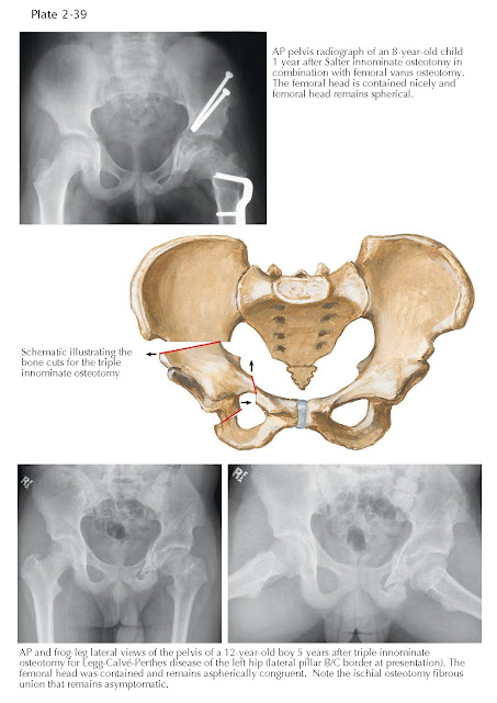 INNOMINATE OSTEOTOMY (CONTINUED)