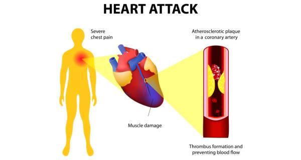 heart-attack