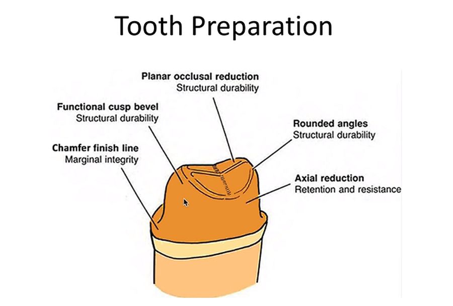 PROSTHODONTICS Tooth Preparation