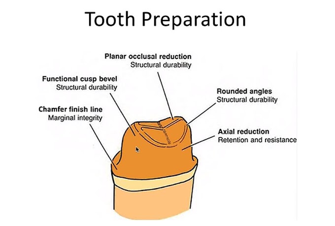 PROSTHODONTICS: Tooth Preparation