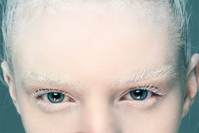 What Is The Treatment Of Leucoderma Vitiligo Latest Treatment Of