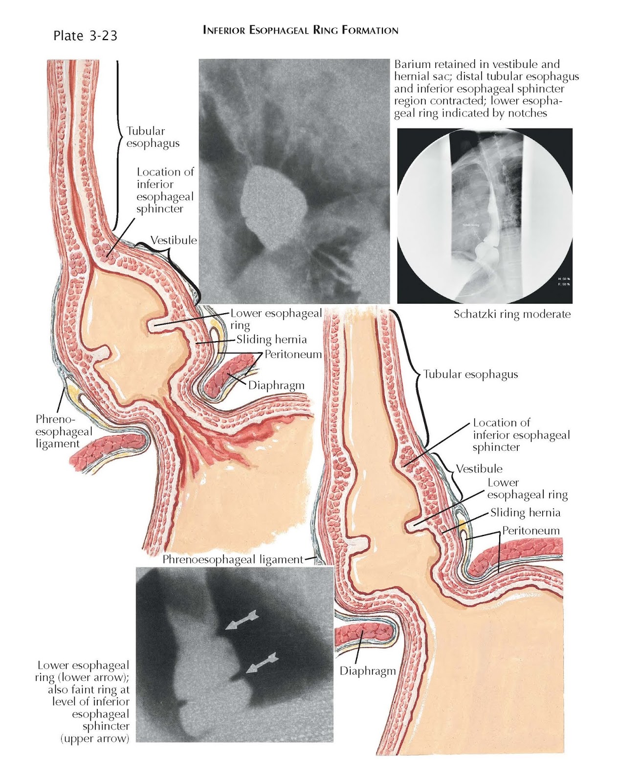 Inferior Esophageal Ring Formation pediagenosis